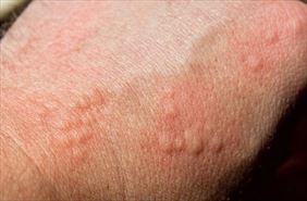 reakcja uczuleniowa, Zenon Siergiejko Prywatny gabinet internistyczno alergologiczny, Białystok