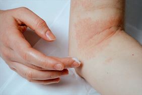 choroba skóry, Anna Ziajka-Paluch Lek. Specj. Chorób Skórnych i Wenerycznych Dermatolog, Cieszyn