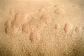 pokrzywka, Dermatolog Małgorzata Karska Piła, Piła