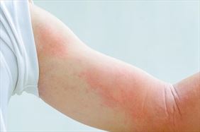 leczenie znamion, Dermatolog Małgorzata Karska Piła, Piła