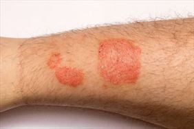 leczenie alergii, Alergo-Med Sp. z o. o. Specjalistyczna Przychodnia Lekarska, Poznań