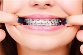 leczenie wad zgryzu, Praktyka lekarsko-dentystyczna Aleksandra Kalina, Warszawa