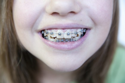 aparat ortodontyczny