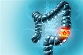 Anna Bielec-Michałowska Prywatny gabinet nowotwór jelita, Anna Bielec-Michałowska Prywatny gabinet chirurgiczny, Opole