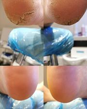 leczenie pięt, Podo-Med Sp. z o.o., Wrocław