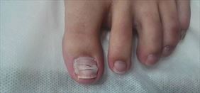 leczenie paznokci, Podo-Med Sp. z o.o., Wrocław