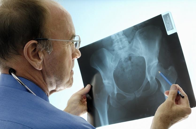 Czym jest osteoporoza? Czym jest osteoporoza?