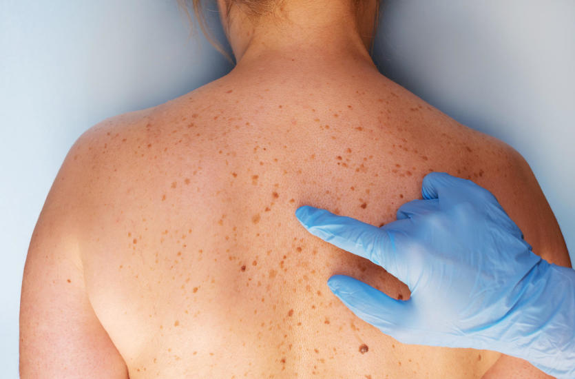 Czym jest dermatoskopia i kiedy warto z niej skorzystać? Czym jest dermatoskopia i kiedy warto z niej skorzystać?