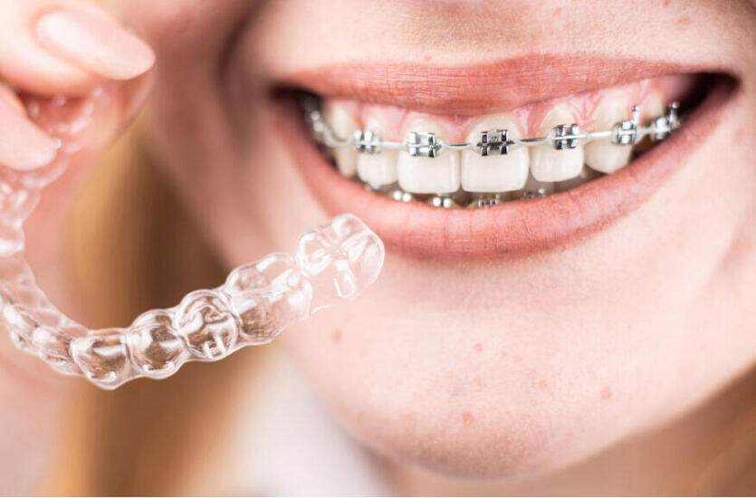 Nowoczesna metoda leczenia ortodontycznego SMILELINE w Gabinecie Stomatologicznym Es-Dent