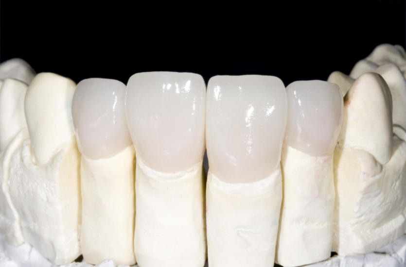 Dobrej jakości porcelana stomatologiczna - gwarancją zadowolonego klienta Dobrej jakości porcelana stomatologiczna - gwarancją zadowolonego klienta