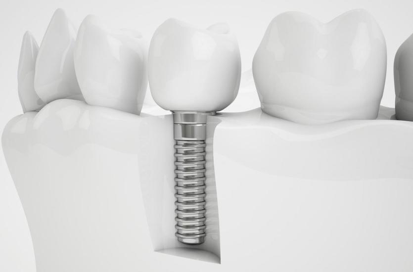 Jakie są nowoczesne metody stosowane w implantologii stomatologicznej?