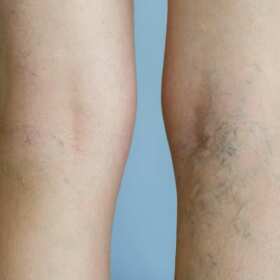 Żylaki - kiedy należy rozważyć operacyjne usunięcie? Lek. Med. Spec. Chirurg Krzysztof Gruszczyński