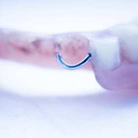 JB Stomatologia: protezy częściowe jako rozwiązanie dla braków w uzębieniu