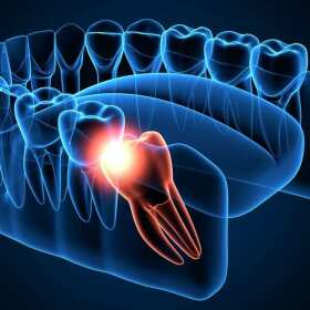 Usuwanie zębów mądrości - co warto wiedzieć przed zabiegiem? JB Stomatologia