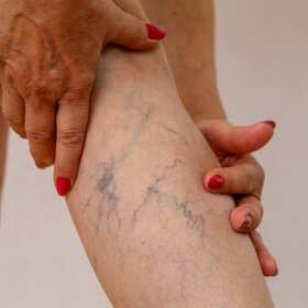 Leczenie żylaków - jak przebiega skleroterapia? Lek. Med. Spec. Chirurg Krzysztof Gruszczyński