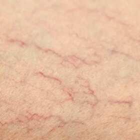 Operacyjne leczenie żylaków - Krzysztof Gruszczyński