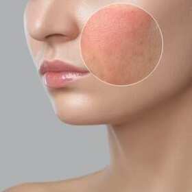 Zabiegi laserowe w dermatologii estetycznej – Olsztyn
