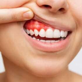 Leczenie chorób przyzębia w Gdańsku – Periodentist