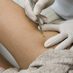 Dlaczego należy usuwać niektóre pieprzyki?