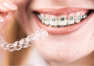 Nowoczesna metoda leczenia ortodontycznego SMILELINE w Gabinecie Stomatologicznym Es-Dent