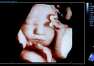 USG 3D w ciąży - rewolucja w diagnostyce prenatalnej. Gabinet ginekologiczny Danuty Kardzis