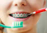 Czy aparat ortodontyczny zwiększa ryzyko próchnicy?