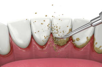  Usuwanie kamienia nazębnego w Gabinecie Stomatologicznym lek. stom. Grażyny Gutowskiej w Kętrzynie