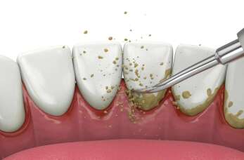 Usuwanie kamienia nazębnego - na czym to polega? Gabinet stomatologiczny Masterdent