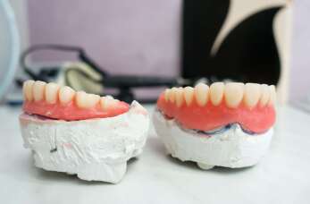 Czym wyróżniają się protezy częściowe ruchome nakładkowe (overdenture)? Pracownia Techniki Dentystycznej