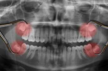 Chirurgiczne usunięcie zęba mądrości - czego się spodziewać? Prywatny Gabinet Dentystyczny Leszek Raczek
