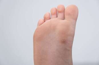 Czy w hotelu można zarazić się kurzajkami?